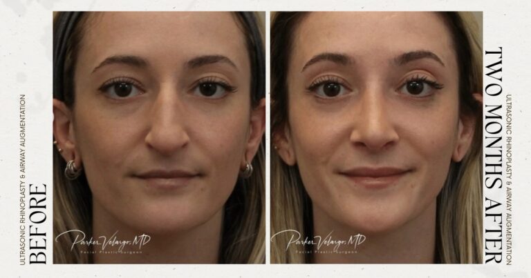 before and after rhinoplasty female patient front view case 12303