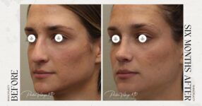 before and after rhinoplasty new orleans female patient left angle view case 12307