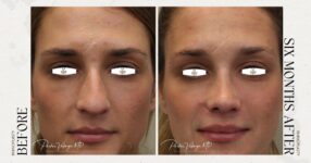before and after rhinoplasty new orleans female patient front view case 12307