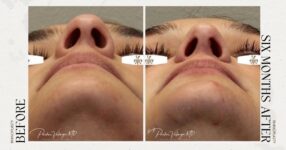before and after rhinoplasty new orleans female patient under view case 12307